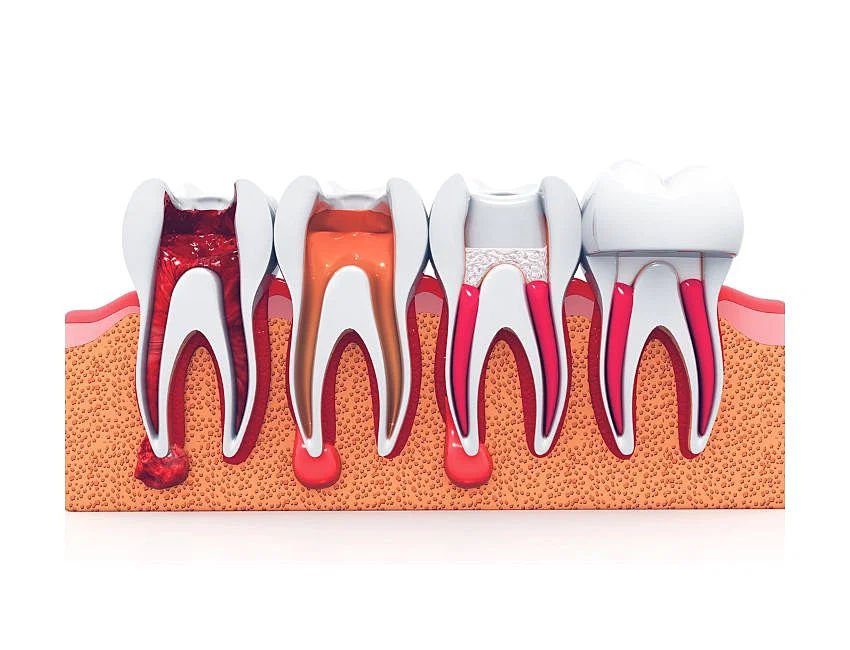 root canal treatment in preston